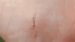 Процесс заживания раны