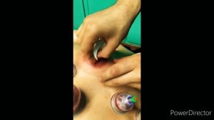 Хиджама с массаж