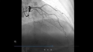 Коронарография. Правый тип кровоснабжения миокарда. Норма