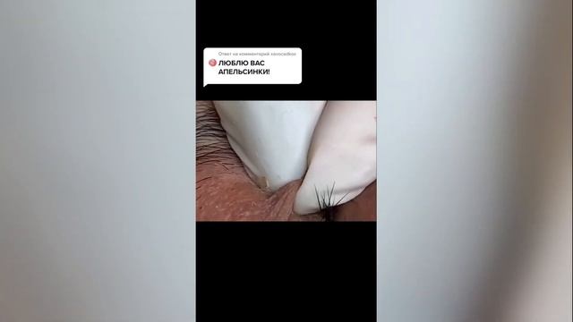 Как правильно выдавливать прыщи на лице: разбираем поэтапное удаление