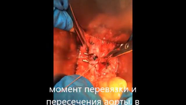 Аорто бедренное протезирование смотреть онлайн