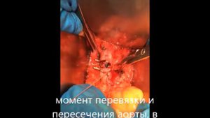 Аорто бедренное протезирование