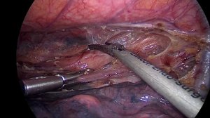 Торакоскопическая экстирпация пищевода / thoracoscopic eosophagectomy