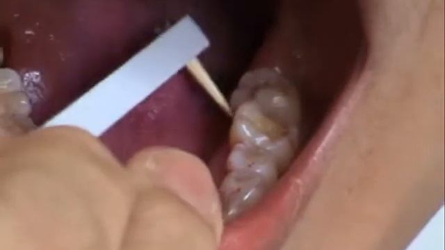 Dent CMU - home care dental aids III - rounded end toothpick with handle I.wmv смотреть онлайн