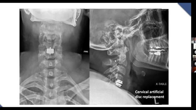 Med School Café - “Back Pain: From Conservative Therapy to Giant Surgery"