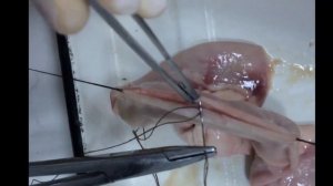 Резекция тонкой кишки.Формирование анастомоза бок в бок.