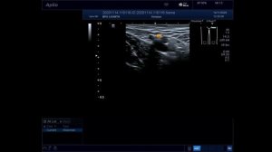 УЗ анатомия вен нижней конечности. Часть 1: Вены бедра. Демонстрация на пациенте.