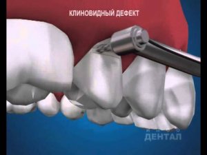 Клиновидный дефект