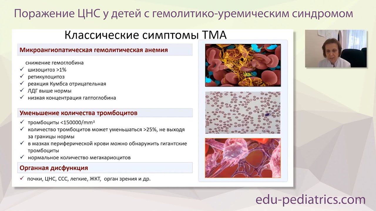 19:00 26.02.2023 Поражение ЦНС у детей с ГУС