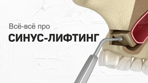 Что такое синус-лифтинг. Его виды, ощущения и сроки восстановления. Разбор реальных случаев.