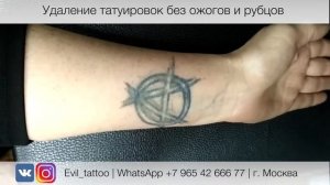 Как удалить татуировку полностью?
