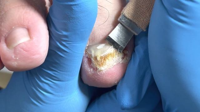 Fungal infection of onychomycosis, the nail bed peels off layer by layer【Pedicure Master Lin Jun】 смотреть онлайн
