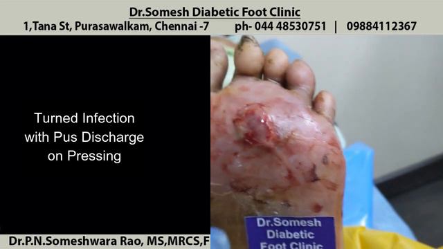 Corn | Callus turned Infection смотреть онлайн