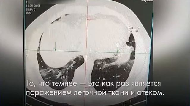 Как выглядят легкие пациента с covid-19 смотреть онлайн