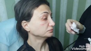 Блефаропластика PLEXR