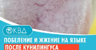 ? Побеление и жжение на языке после кунилингуса. Клинический случай №664
