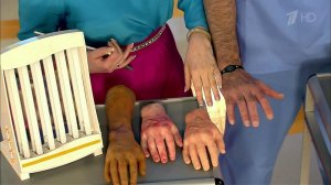 Солнечный ожог. Как не сгореть на солнце. Жить здорово! Фрагмент выпуска от 27.06.2013