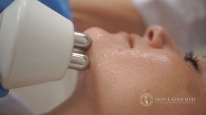 RF лифтинг лица. РФ лифтинг. Радиоволновой лифтинг