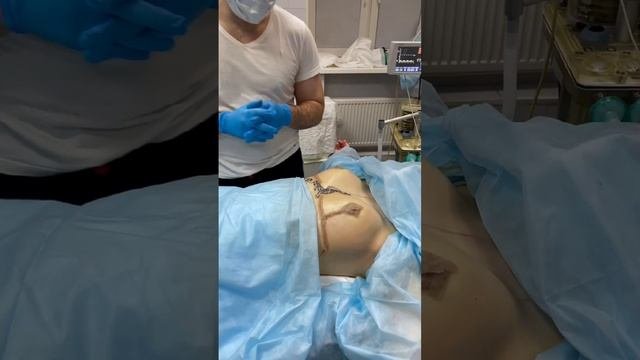 Подтяжка груди с небольшим уменьшением