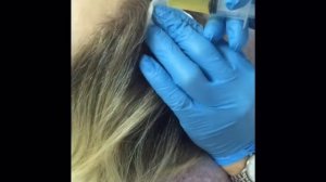 Плазмолифтинг волосистой части головы