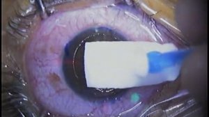 Dr. Archie Agahan LASEK (Laser epithelial keratomileusis) refractive surgery