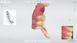 3Shape TRIOS- Implant restoration workflow IT