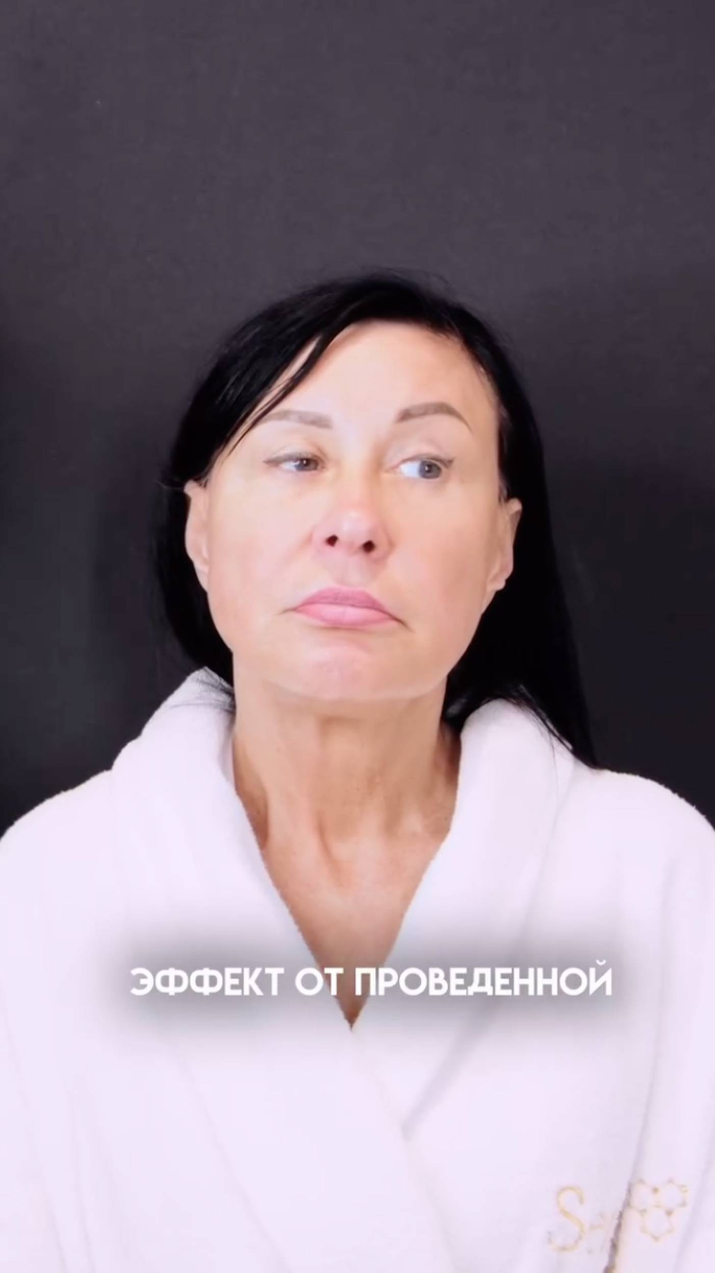 Повторная подтяжка лица спустя 10 лет!  #золотовсергей  #подтяжкалица  #пластикалица