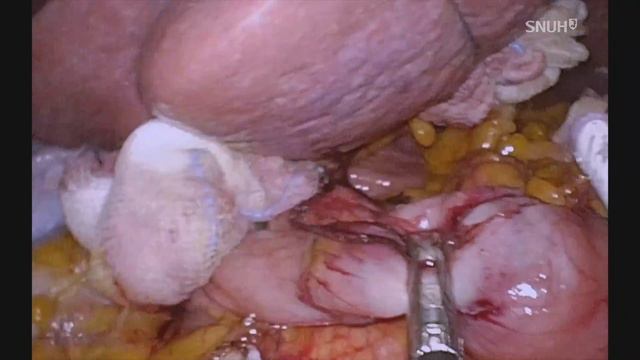 Single Incision Distal Gastrectomy with delta anastomosis смотреть онлайн