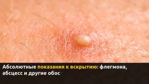 Вскрытие фурункула