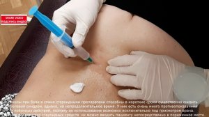 Back Pain Local Injections Лечение БОЛЬ В СПИНЕ Остеохондроз Грыжа Диска