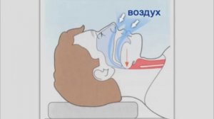 Проведение сердечно лёгочной реанимации с использованием автоматического дефибрилятора