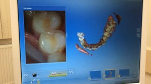 Протезирование зубов по технологии CEREC (ЦЕРЕК)