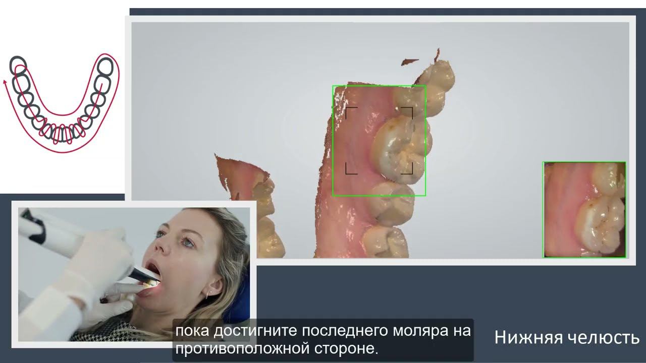 3Shape TRIOS. Стратегии сканирования – Полный зубной ряд.