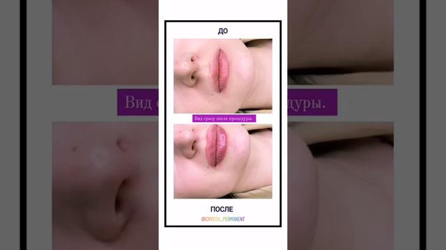 Мой опыт: Увеличение губ. Juvederm 3. 1ml смотреть онлайн
