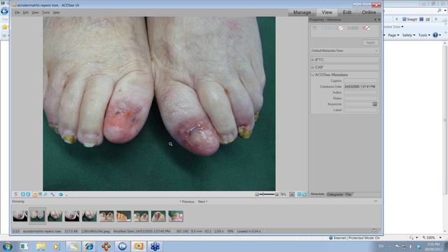 2012 09 28 15 52 Globalskinatlas Acrodermatitis of Hallopeau смотреть онлайн