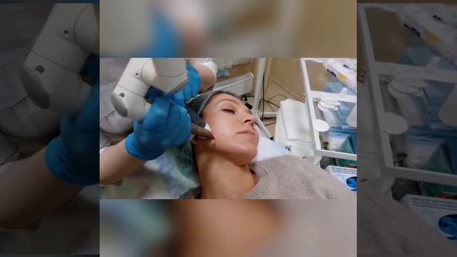 Лазерный пилинг в Эстетик Клубе смотреть онлайн