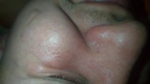 Давим прыщИ, угри, жесть. Бедный нос))))