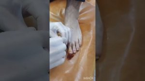 Подногтевая гематома. Правильное лечение.