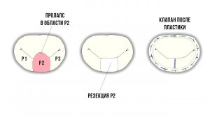 Миниинвазивная (торакоскопическая) пластика митрального клапана