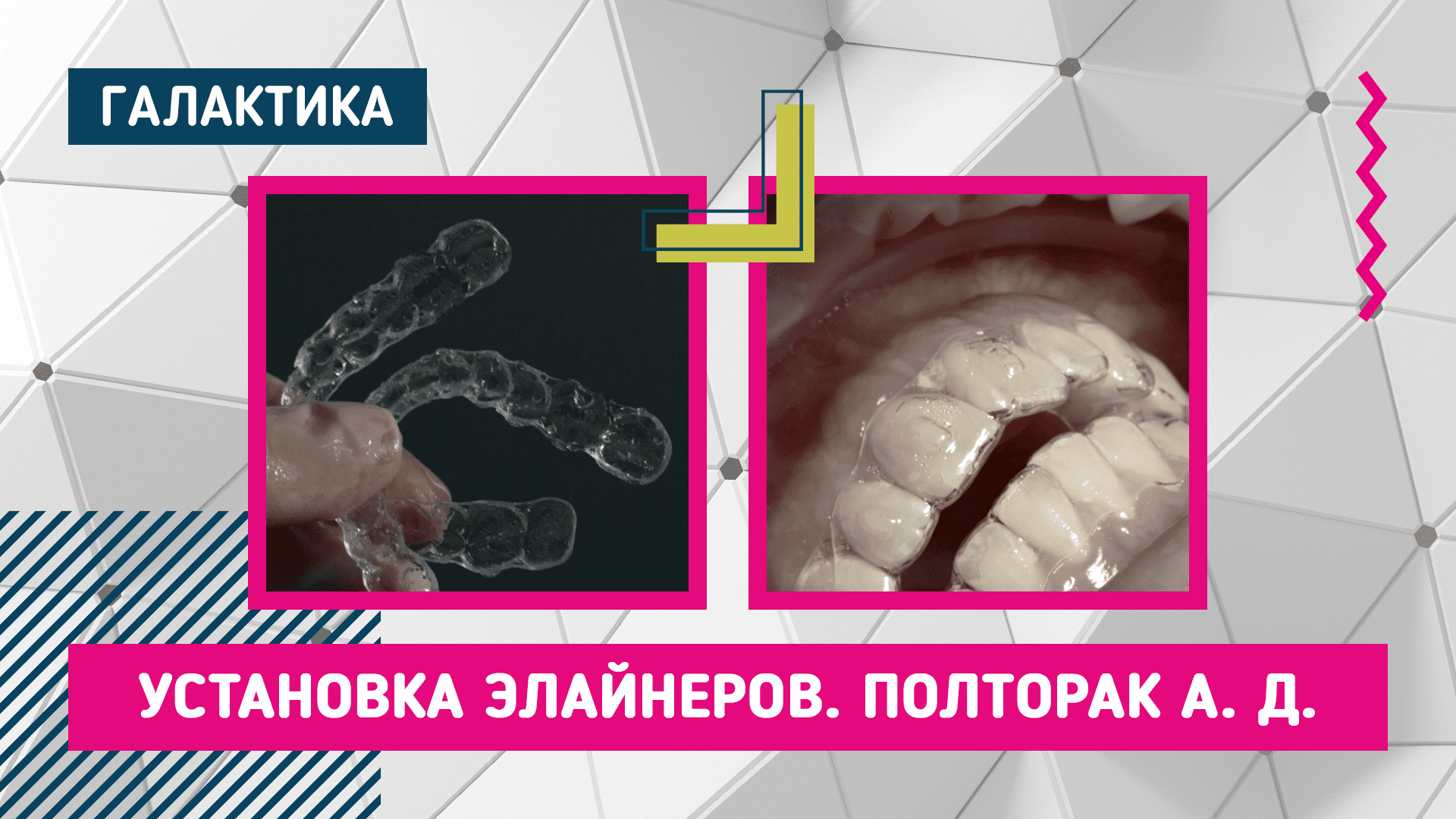 Лечение зубов элайнерами | Полторак Ася Дмитриевна #элайнеры #лечениеэлайнерами