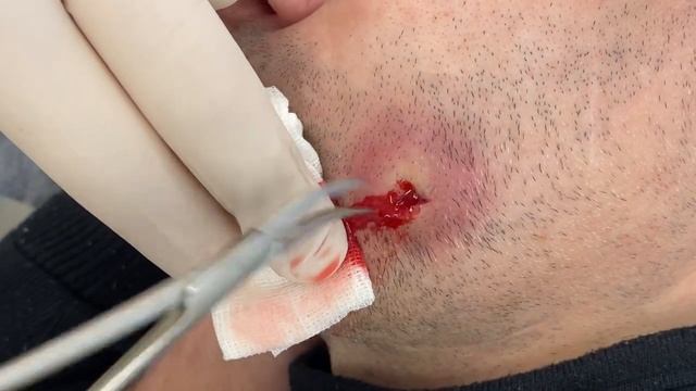 ГНОЙ идёт в полость РТА! БЫСТРО и эффективно смотреть онлайн