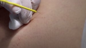 Склеротерапия Удаление сосудистых звездочек
