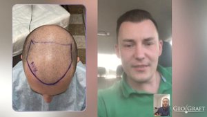 ПЕРЕСАДКА ВОЛОС В МОСКВЕ / ОТЗЫВ ПАЦИЕТА