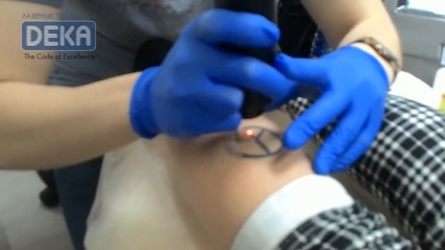 Удаление татуировки на лазере Synchro QS4 (1-й сеанс) смотреть онлайн