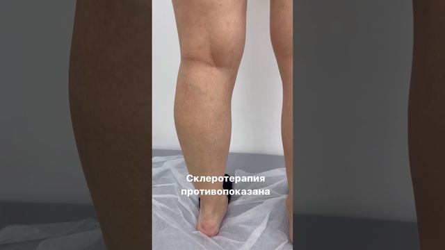 Сосудистая сетка. Склеротерапия противопоказана. Варикоза нет. Флеболог Москва. Флеболог смотреть онлайн
