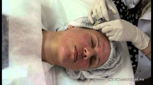 Биоревитализация области вокруг глаз