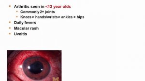 USMLE RX - 8.Анатомия - 3.Патология - 23.Системный Ювенильный идиопатический артрит* (сЮИА)