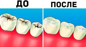 Естественный Способ Отбеливания Зубов В Домашних Условиях