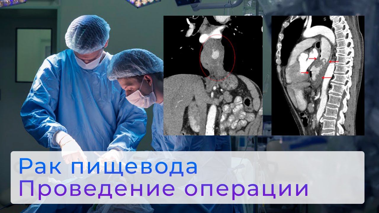 Рак пищевода - проведение хирургической операции | Химиотерапия