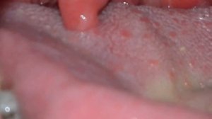 Удаление миндальных камней #2